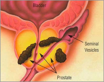 prostate_stage3[2].jpg